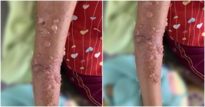 Tay bé gái 8 tuổi nổi nhiều bóng nước sau khi tắm biển