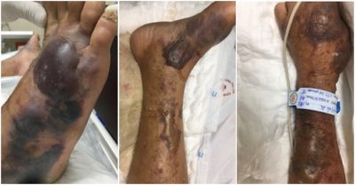 Người đàn ông nhiễm ‘vi khuẩn ăn thịt người’ sau khi ăn hàu sống