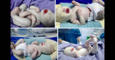 Thêm 1 cháu bé có toàn thân bọc vảy trắng nhiều vết nứt