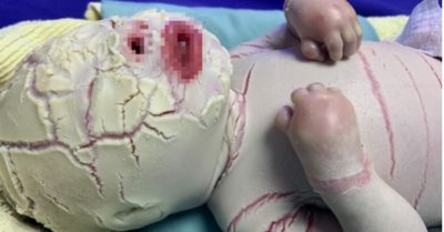 Bé sơ sinh ở Quảng Ninh da khô cứng do bệnh cực hiếm