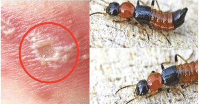 Hàng nghìn người nhập viện vì kiến ba khoang: Chỉ cần dùng chanh hoặc sả để ‘đuổi bay’