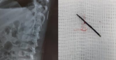 Bé gái 3 tuổi sốt cao trong nhiều ngày do kim khâu đâm vào đốt sống