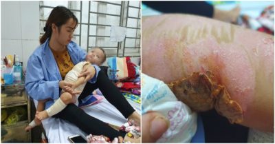 Tin lời thầy lang chữa bỏng 25 triệu đồng, người mẹ nói trong ân hận: ‘Suýt nữa thì hại con rồi’