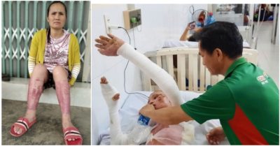 Người mẹ hai lần ‘lóc da’ cứu con: ‘Dường như mình đã sinh con ra lần nữa’