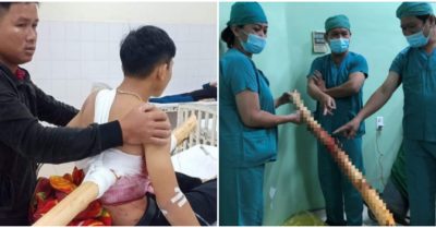Video: Phẫu thuật lấy thân cây ra khỏi người nam sinh