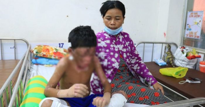 Cậu bé dũng cảm cứu mẹ nuôi bị bỏng 60%