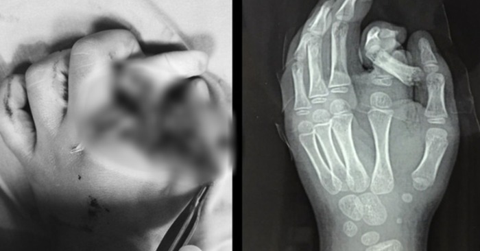 Hình ảnh ngón tay bệnh nhi bị xoắn vặn trên phim chụp X quang (ảnh bệnh viện công bố).