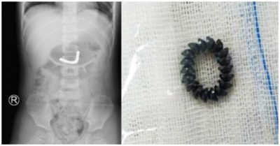 Phẫu thuật thành công cho bé trai 3 tuổi nuốt 18 viên nam châm trong máy massage mắt