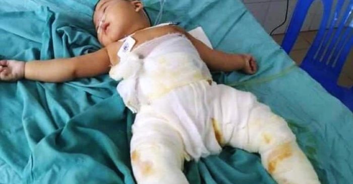 Cháu Linh ngã vào chậu than, đang điều trị tại bệnh viện.