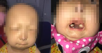 Bé gái 6 tuổi bị lão hóa như người già