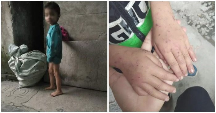 Hình ảnh cháu bé ăn mặc thiếu thốn giữa trời rét và bàn tay với nhiều vết thương.