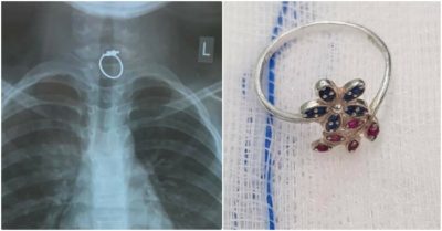 Gắp chiếc nhẫn ra khỏi thực quản bé gái 10 tuổi