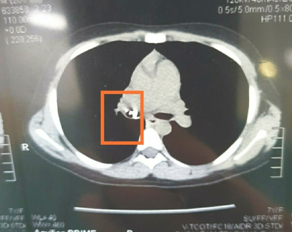 Hình ảnh kiểm tra của bác sĩ cho thấy dị vật cản quang nằm trong đường hô hấp của bệnh nhi.