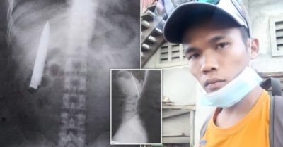 Thỉnh thoảng đau nhói ngực, thanh niên choáng váng khi phát hiện lưỡi dao 10cm găm trong cơ thể