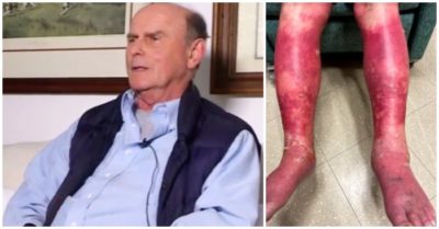 Mỹ: Cụ ông bị lột da từng mảng sau khi tiêm vắc xin COVID-19