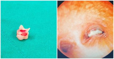 Gắp chiếc răng hàm nằm trong phổi bé gái suốt 2 tháng