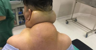 Cơ thể người đàn ông bị biến dạng do nghiện rượu