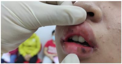 Tô son 5.000 đồng/hộp quảng cáo trên Facebook, thiếu nữ bị sưng môi, rỉ máu phải đi viện