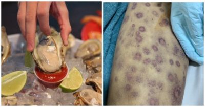 Ăn hàu sống, người đàn ông tử vong do nhiễm vi khuẩn tả biển