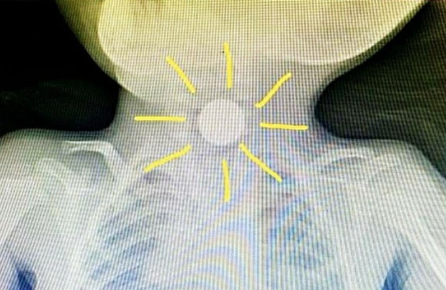 Hình ảnh viên pin trên phim X quang (ảnh chụp màn hình trên báo VnExpress).