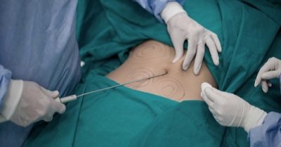 Nữ bệnh nhân 50 tuổi tử vong sau 3 ngày hút mỡ bụng