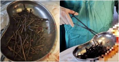 Hơn 1kg đinh và ốc vít trong dạ dày của nam bệnh nhân