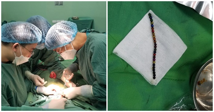 Sau 3 giờ phẫu thuật, các y bác sĩ đã lấy 25 viên bi đồ chơi ra khỏi ổ bụng của bệnh nhi (ảnh chụp màn hình trên báo VietNamNet).