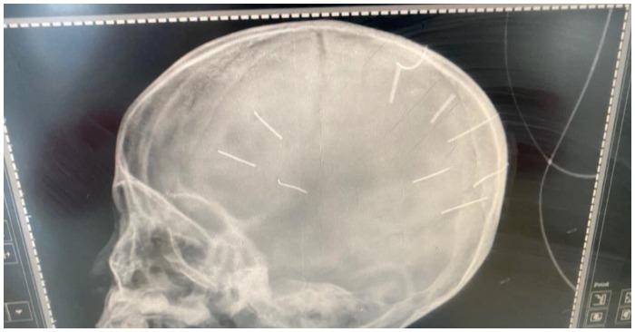 Hình ảnh phim chụp cho thấy hộp sọ của bệnh nhi có 9 đinh (ảnh chụp màn hình trên báo Doanh Nghiệp và Tiếp thị).