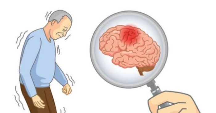 Những dấu hiệu cảnh báo bệnh nhồi máu não, cần lưu ý để tránh gây hại cho sức khỏe