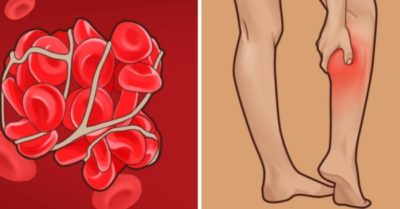 Những dấu hiệu cảnh báo nguy cơ có cục máu đông trên cơ thể, cần nhận biết sớm để điều trị