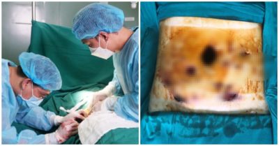 Bụng bị thủng 15 lỗ sau tiêm chất tan mỡ bụng mua ở Campuchia