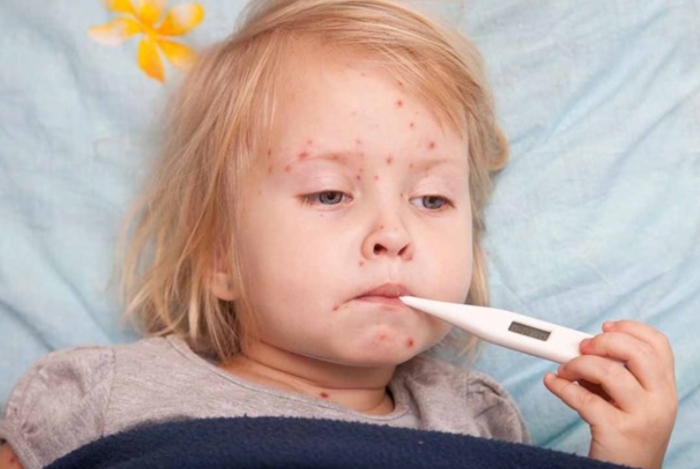 Những dấu hiệu nhận thấy trẻ bị sốt xuất huyết