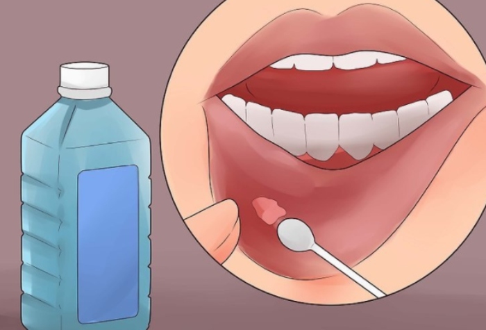 Thường xuyên viêm loét miệng không nên chủ quan, để lâu rất khó chữa trị