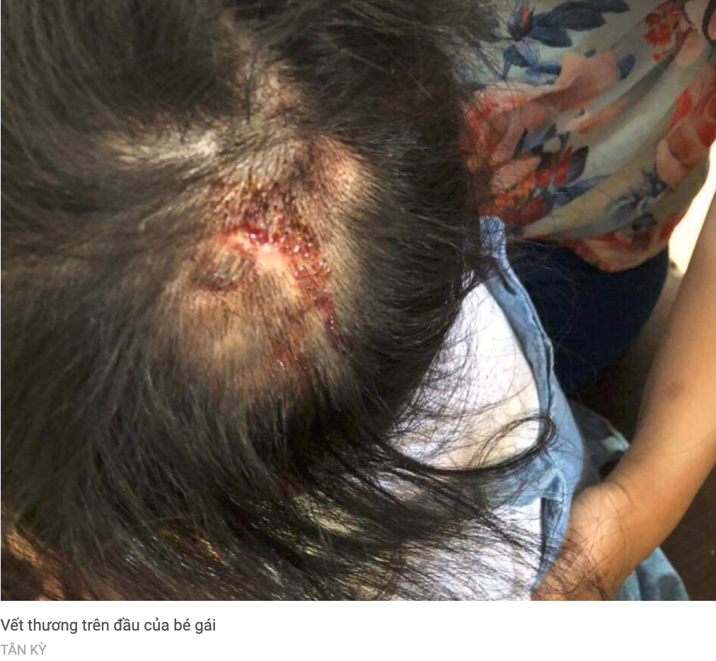 Hà Tĩnh: Bé gái 4 tuổi bầm tím khắp người, đầu rỉ máu, nghi bị bạo hành 